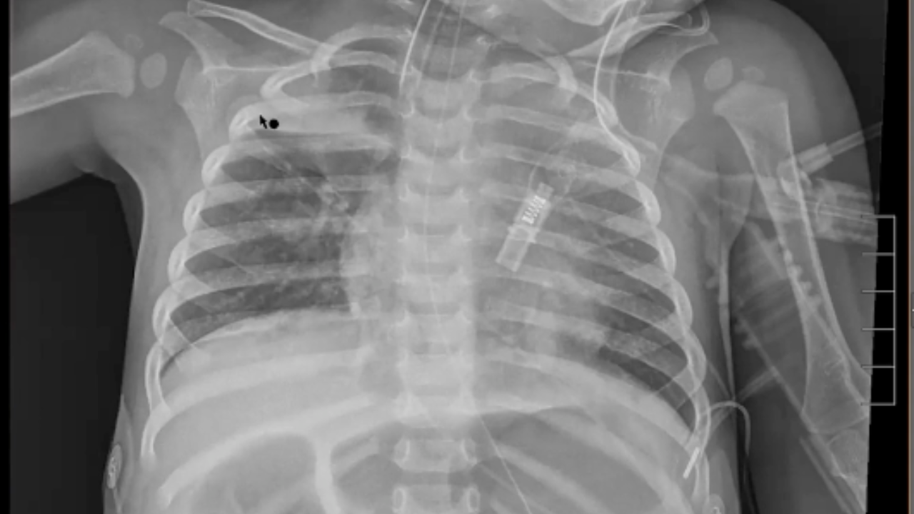 10 month old infant with repeated infections of right upper lobe ...