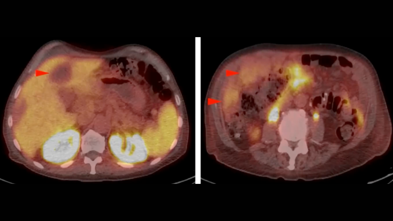 Introduction to Reading Oncology PET/CT, Dr. Lacey J. McIntosh (1-17-24 ...