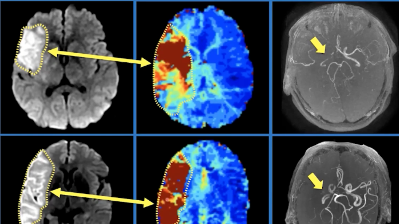 Acute Ischemic Stroke Imaging and Thrombectomy Treatment, Dr. Jeremy J ...