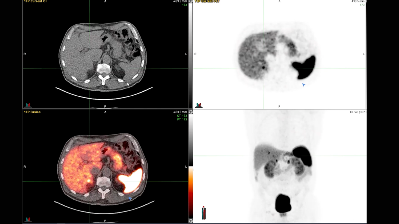 DOTATATE: Common Pitfalls and Benign Lesions - MRI Online is now Medality